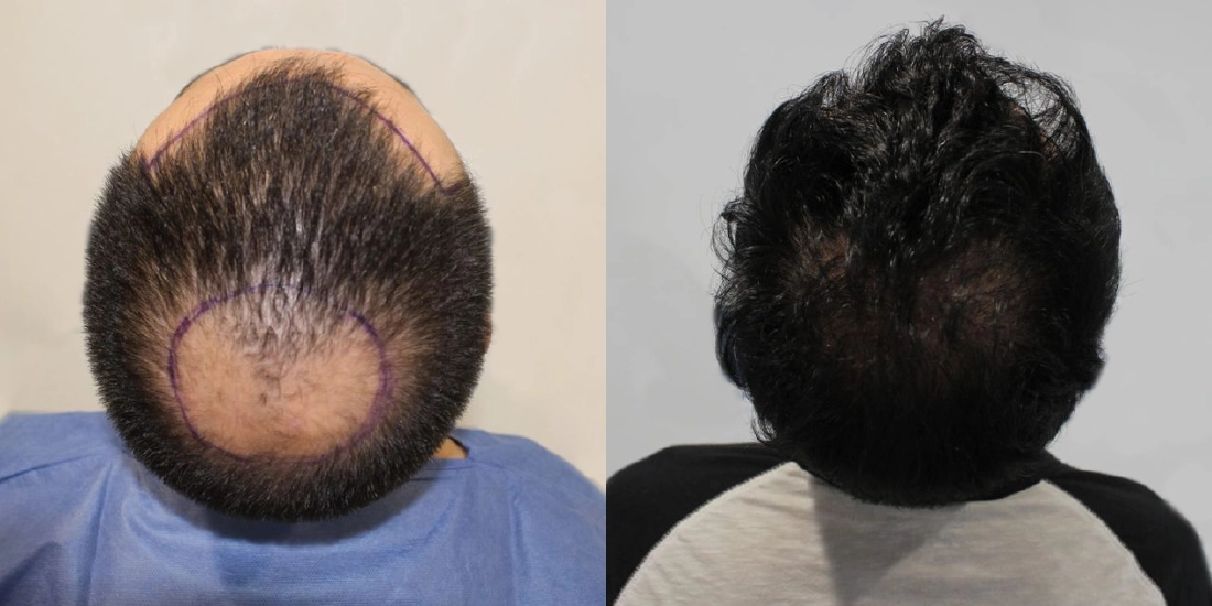 DHI Saç Ekim Öncesi ve Sonrası