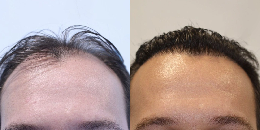 DHI Tekniği Saç Ekim Öncesi ve Sonrası