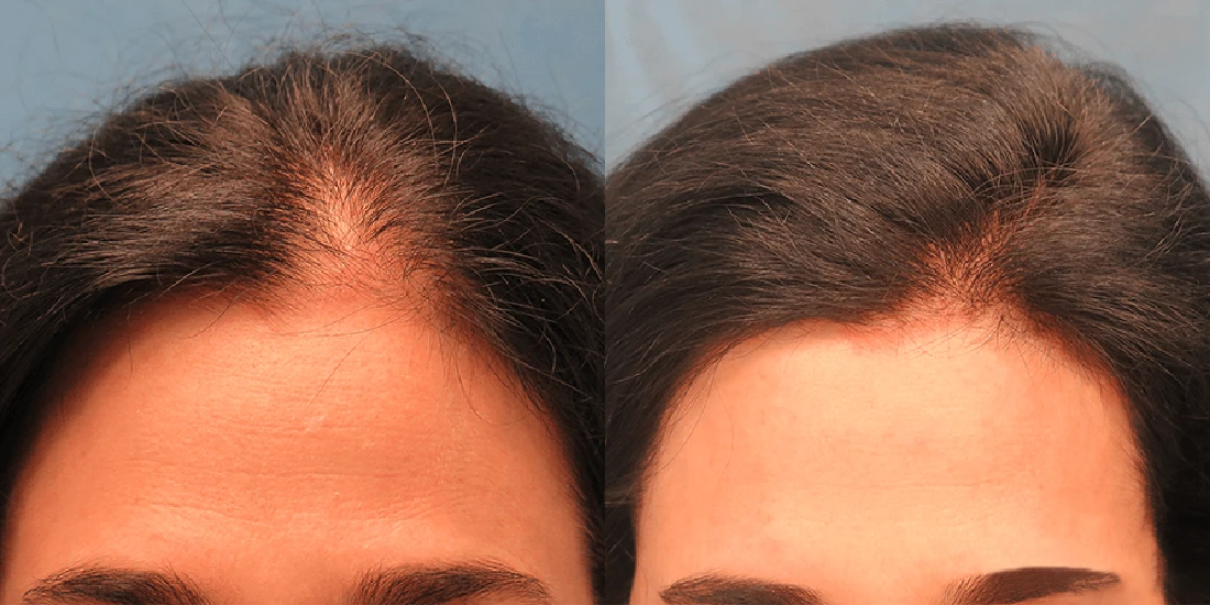 Kadınlarda Saç Ekimi Öncesi ve Sonrası