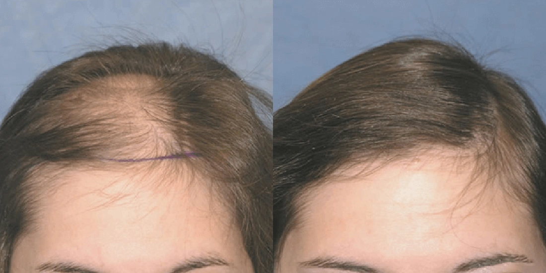 Kadınlarda Saç Ekim Öncesi ve Sonrası